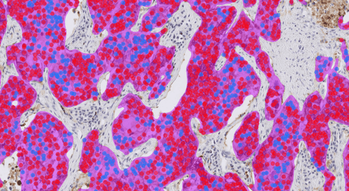 Southampton case study: AI-driven analysis of PD-L1 lung cancer