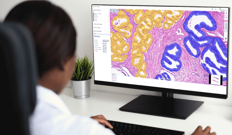 gleason grading of prostate cancer